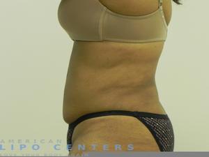 americanlipocenters_26.jpg
